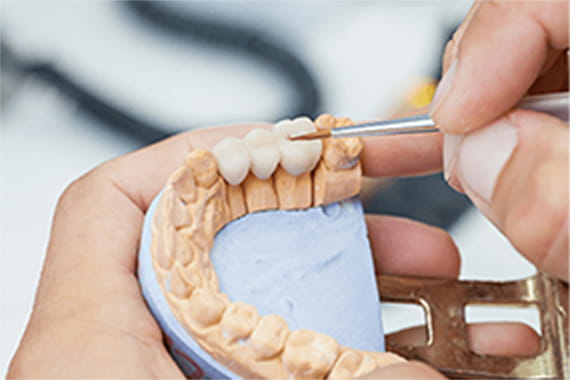 印象採得、咬合採得