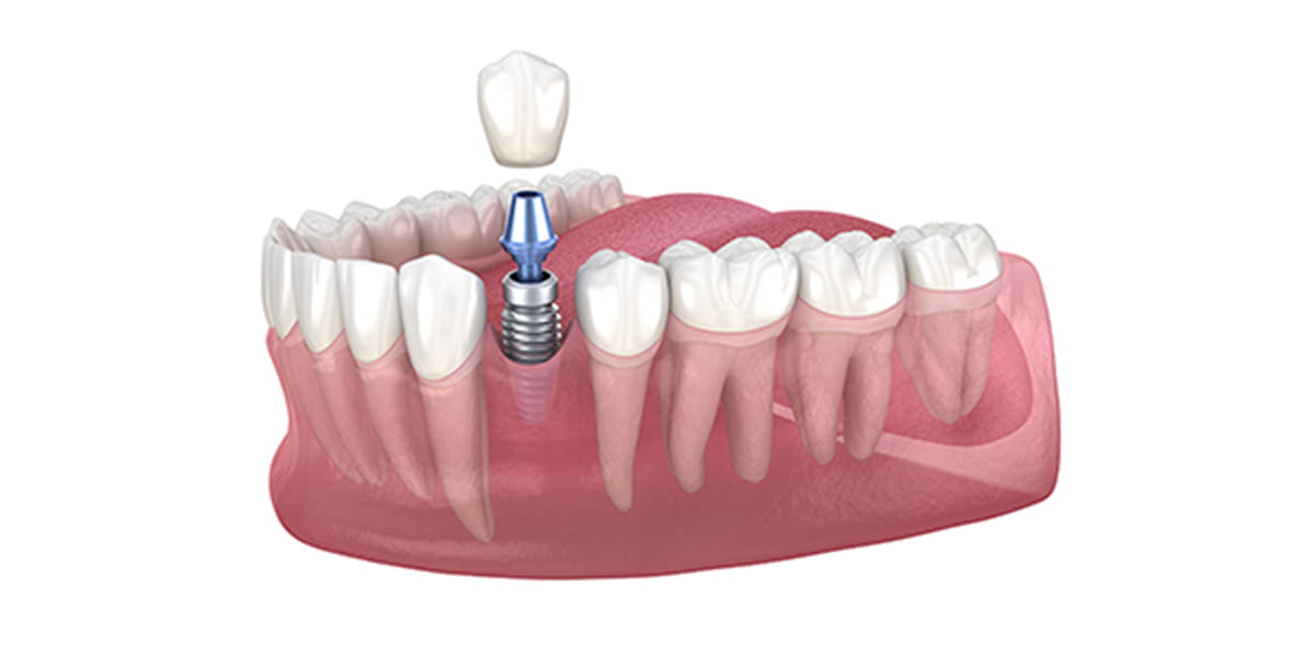 1本のインプラント
