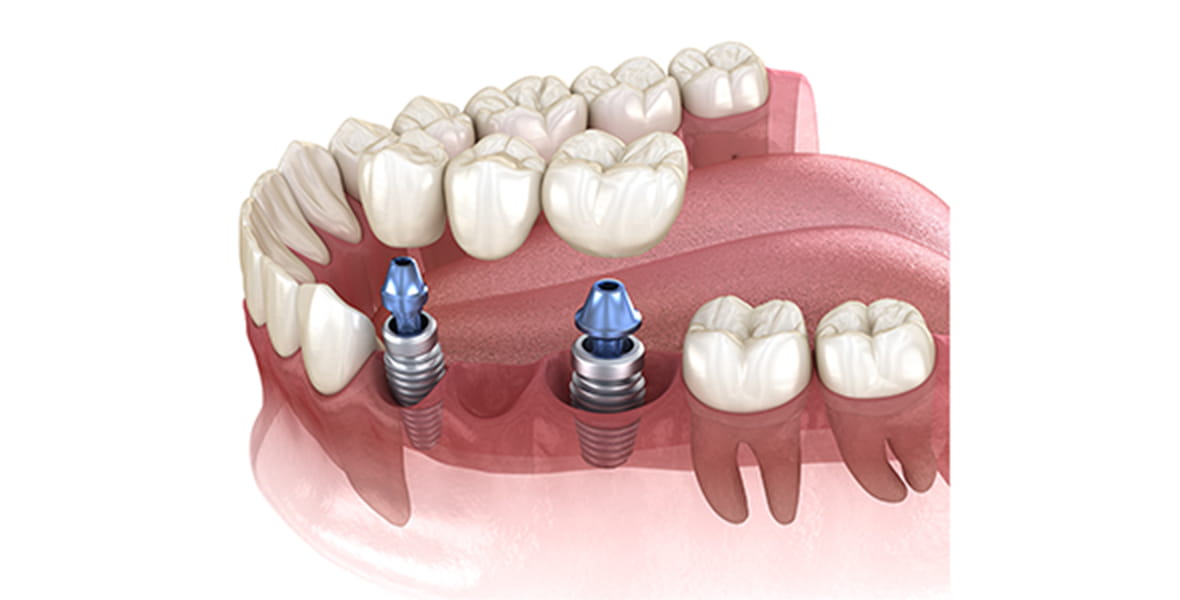複数本のインプラント
