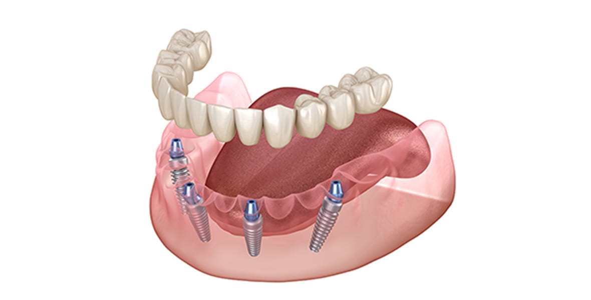 全ての歯のインプラント